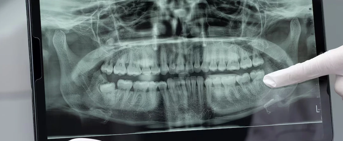Dijital diş hekimliği: CAD/CAM teknolojileri