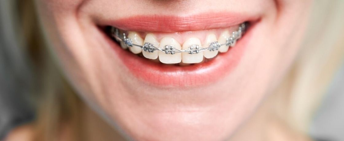 Ortodontik Tedavi Nedir? Kimler İçin Uygundur?